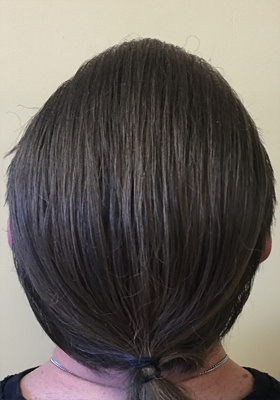 hair transplant before after Photos