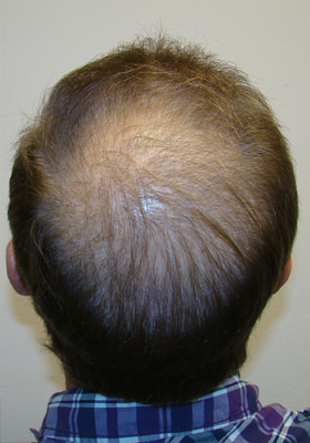 hair transplant before after Photos