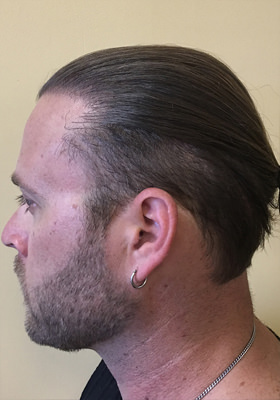 hair transplant photos