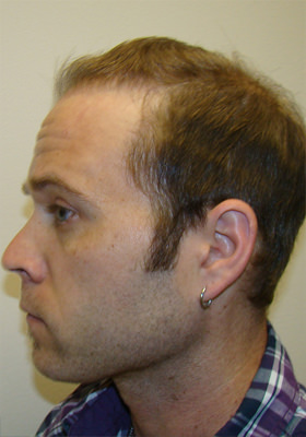 hair transplant before after Photos