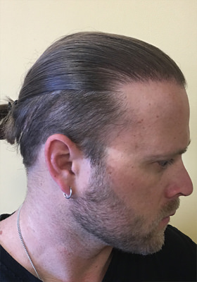 hair transplant before after Photos