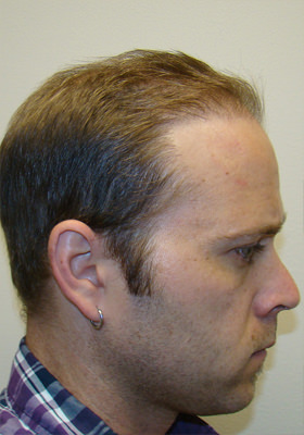 hair transplant photos