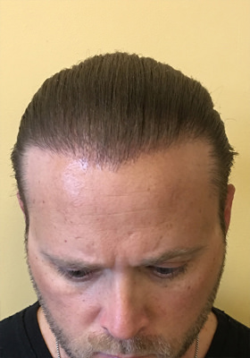 hair transplant before after Photos