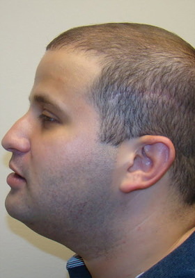 hair transplant photos