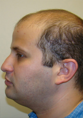 hair transplant before after Photos