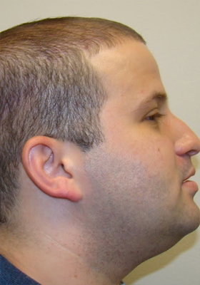 hair transplant before after Photos