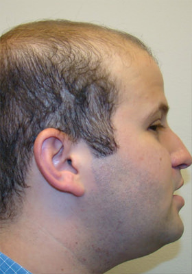 hair transplant photos