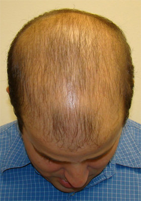 hair transplant before after Photos