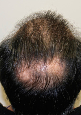 hair transplant before after Photos