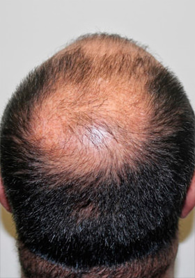 hair transplant before after Photos