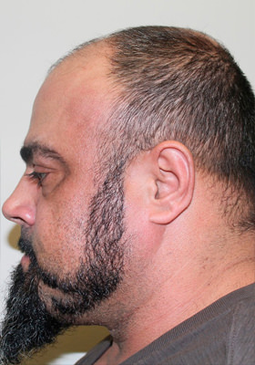 hair transplant photos