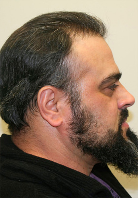 hair transplant before after Photos