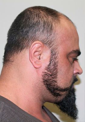 hair transplant before after Photos