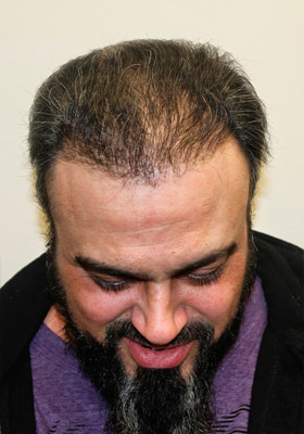 hair transplant photos