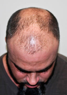 hair transplant photos