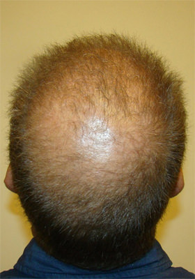 hair transplant before after Photos