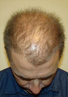 hair transplant photos