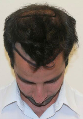 hair transplant photos