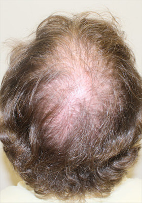 hair transplant photos