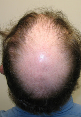 hair transplant photos