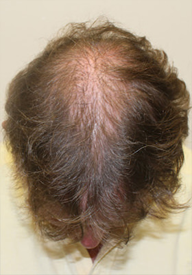 hair transplant photos