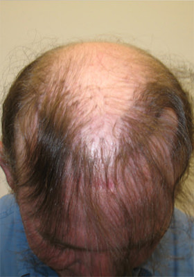 hair transplant photos