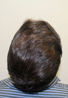 hair transplant photos