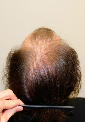 hair transplant before after Photos