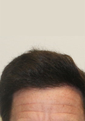 hair transplant photos