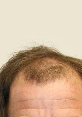 hair transplant photos