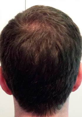 hair transplant before after Photos