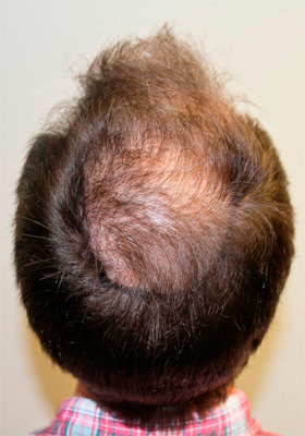 hair transplant before after Photos