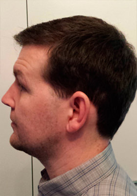 hair transplant before after Photos