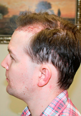 hair transplant before after Photos