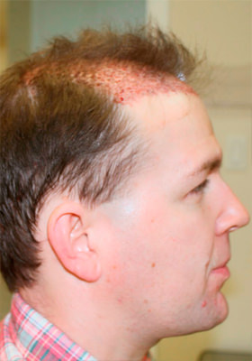 hair transplant photos