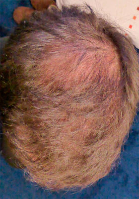 hair transplant photos