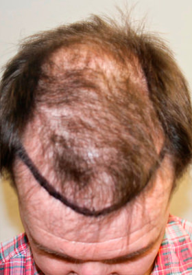 hair transplant before after Photos