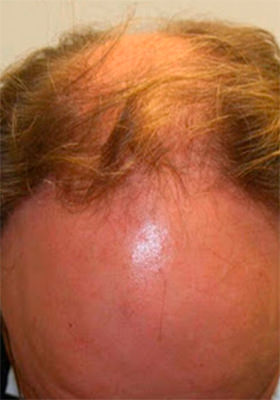 hair transplant photos