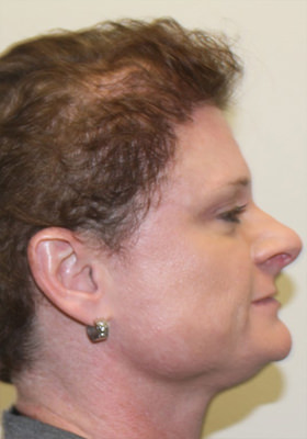 hair transplant photos