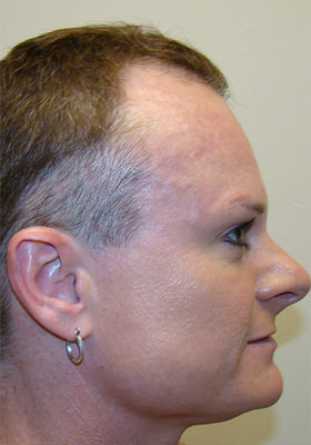 hair transplant before after Photos