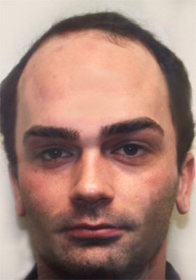 hair transplant photos