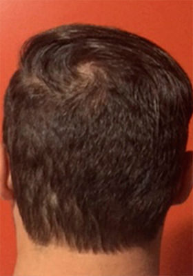 hair transplant before after Photos