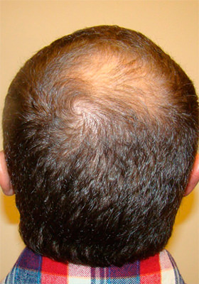 hair transplant photos