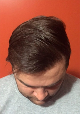 hair transplant before after Photos