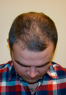 hair transplant photos