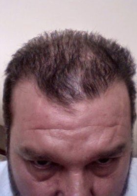 hair transplant photos