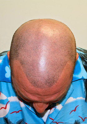 hair transplant photos