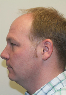 hair transplant photos