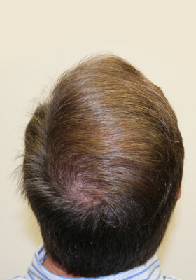 hair transplant before after Photos