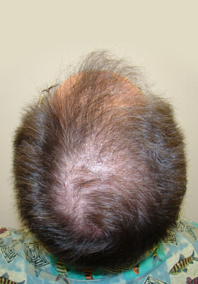 hair transplant photos